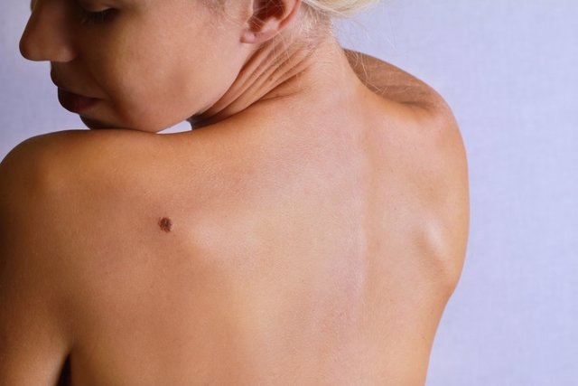 Young woman lookimg at birthmark on  back, skin.