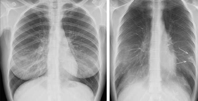 A la izquierda, una prueba de rayos X convencional. A la derecha, una imagen de un plano de tomosíntesis en la que se Identifica con claridad la patología que no se aprecia en la imagen de la izquierda.