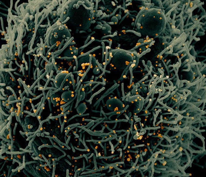 Micrografía electrnica d'escombratge acolorida d'una cllula apoptótica, en verd, infectada amb partícules del virus SARS-COV-2, en color taronja, allada d'una mostra de pacient.