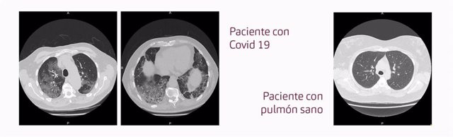 Pulmones de un paciente con Covid-19