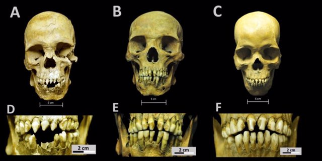 Cráneos y dentaduras de tres individuos de origen africano hallados en el Real Hospital de San José de los Naturales