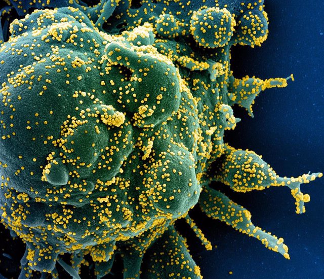 Micrografía electrónica de barrido coloreada de una célula infectada con partículas del coronavirus