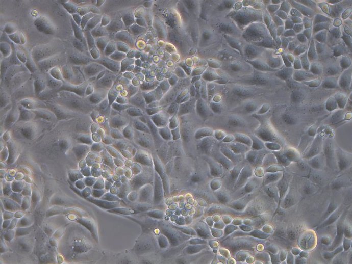 Fotos de líneas celulares de carcinoma seroso de alto grado de ovario