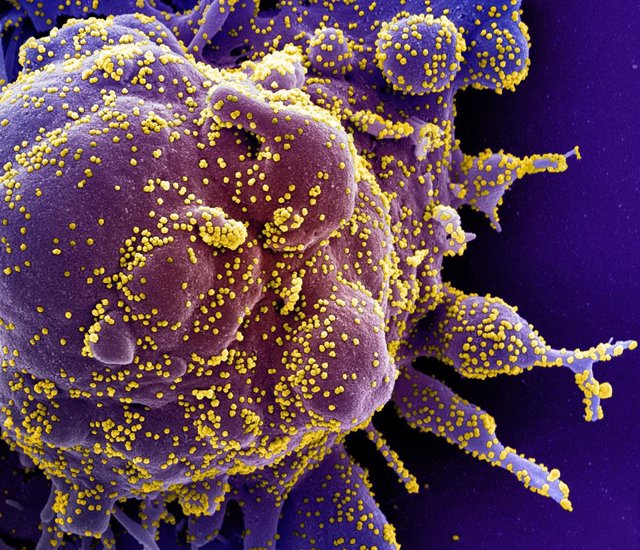 Micrografía electrónica de barrido coloreada de una célula apoptótica, en morado, infectada con partículas del virus SARS-COV-2, en color amarillo, aislada de una muestra de paciente.