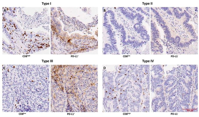 Imagenes de la investigación sobre aplicación de inmunoterapia en pacientes con tumores de fosas nasales.