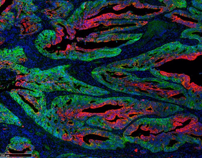 La capacidad biosintética es clave para erradicar células madre tumorales, según un estudio