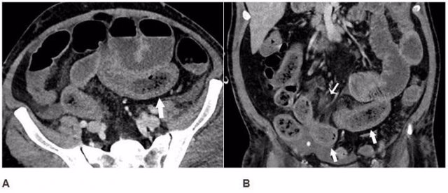 Anormalidades en el intestino de los pacientes con Covid-19