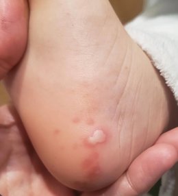 El Hospital Costa del Sol participa en un estudio de dermatología sobre los efectos en la piel del COVID-19