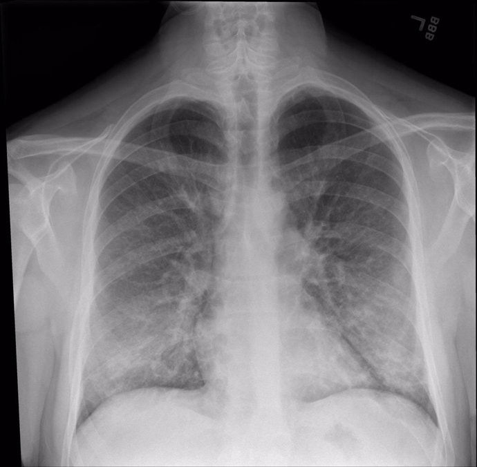 Radiografía de tórax de un paciente que está siendo tratado por una lesión pulmonar asociada a vapeo o cigarrillo electrónico.