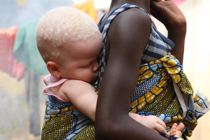 Un niño albino en Freetown, Sierra Leona