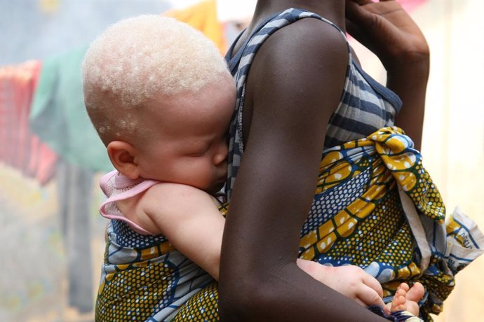 Malaui.- La ONU alerta de que 53.000 menores albinos en Malaui pueden ser asesin