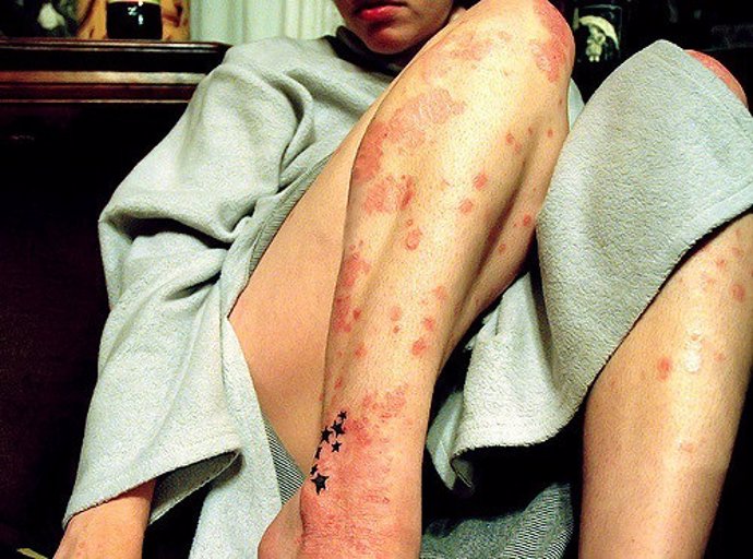 PSORIASIS