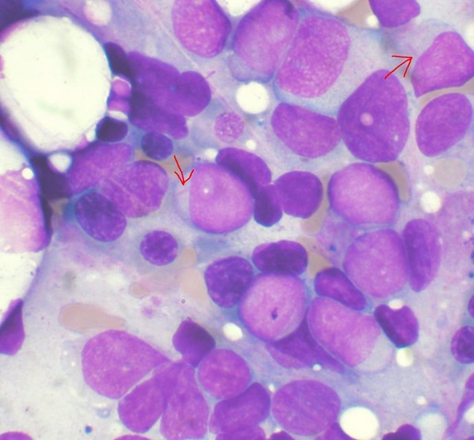 Un descubrimiento sobre la leucemia mieloide aguda podría proporcionar una vía p