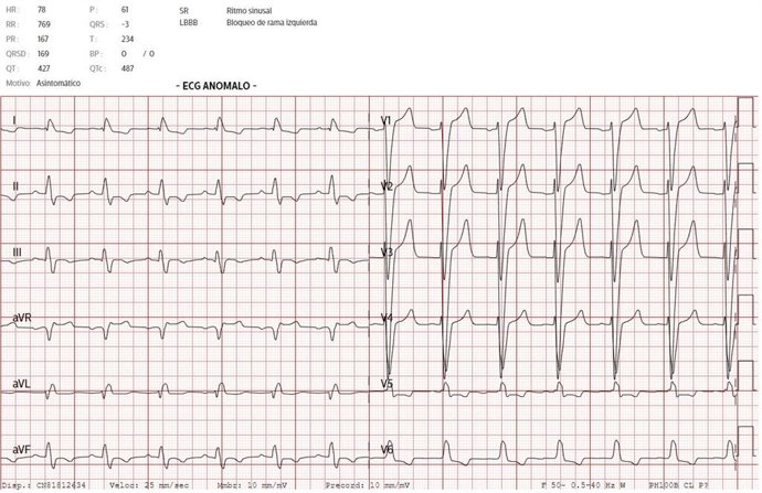 Un electrocardiograma anómalo.