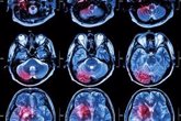 Foto: CRIS Contra el Cáncer impulsa 4 proyectos de investigación en tumor cerebral en Londres, París y Madrid