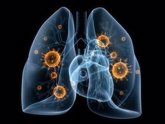 Foto: Cáncer de pulmón, uno de los tumores que más ha mejorado su supervivencia en la última década