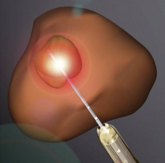 Ablación por láser del cáncer de próstata