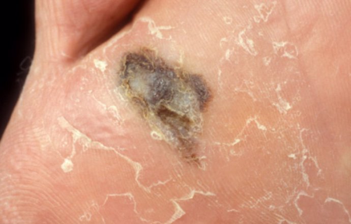 Imagen de un melanoma en un pie.