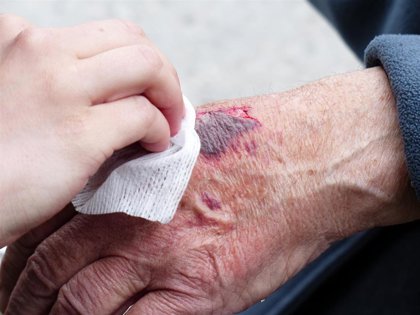 La variación genética puede afectar la curación de las heridas