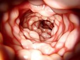 Foto: La terapia celular mejora un 50% la calidad de vida de enfermos de Crohn con fistulas perianales