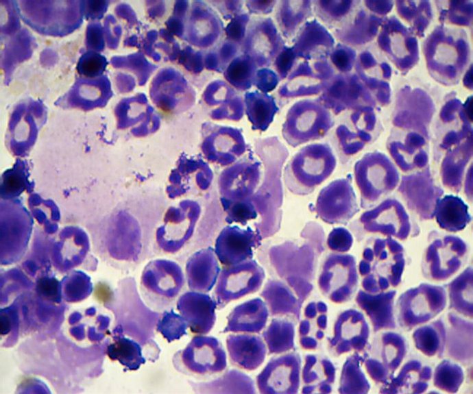 Las mutaciones de las células sanguíneas relacionadas con las leucemias son inev