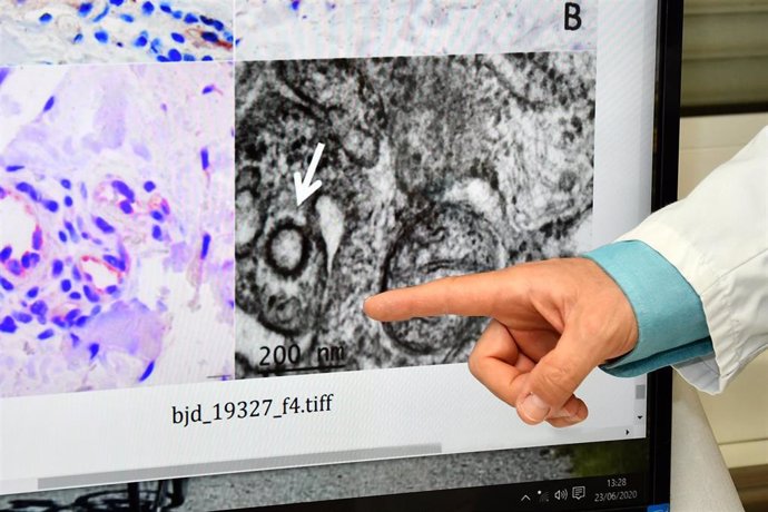 Los investigadores han conseguido fotografiar al virus en la piel, gracias a las biopsias realizadas en lesiones de tipo sabañones en niños (muchos de ellos habían dado negativo en la PCR) .