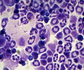 Foto: Investigadores prueban a inhibir una proteína específica de un tipo de leucemia para reducir el número de megacariocitos