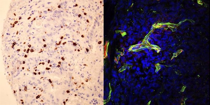 Izquierda: Linfocitos citotóxicos (en marrón) infiltrando un tumor colorectal con altos niveles de SOD3. Derecha: Células tumorales donde se observa la proteína de la membrana basal (en verde) que permite que los linfocitos accedan al tumor