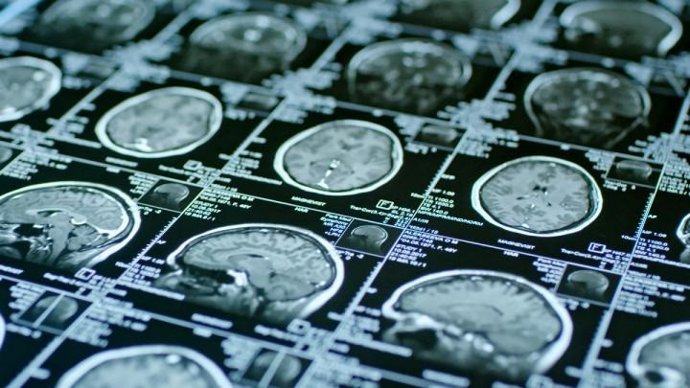 La acumulación de hierro en el cerebro, relacionada con el deterioro cognitivo e