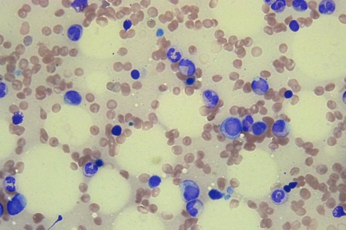 Imagen de médula ósea sana, con  glóbulos rojos maduros (pequeños discos de color rosado), glóbulos rojos que aún se están desarrollando (en azul profundo) y glóbulos blancos  en desarrollo (en azul más claro).