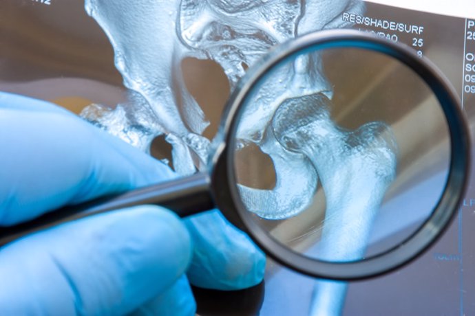 Osteosarcoma, problemas en los huesos