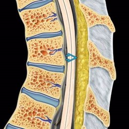 Lipomatosis espinal