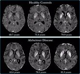 Foto: La proximidad a la edad parental de inicio del Alzheimer indica mayor riesgo de desarrollar la enfermedad en mujeres
