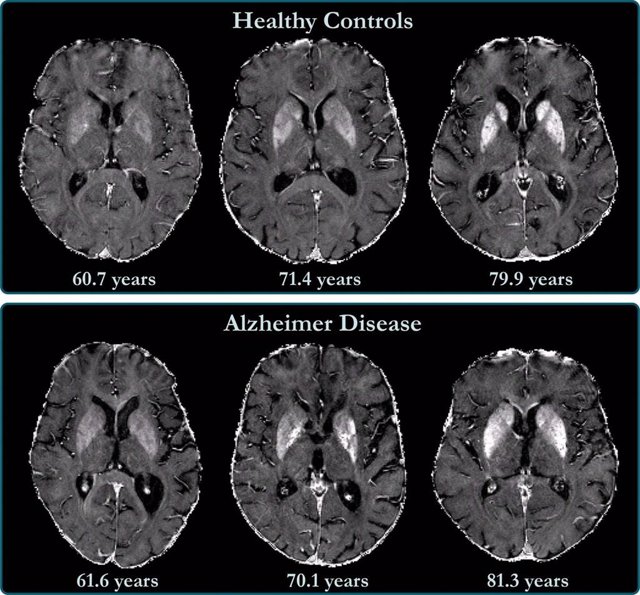 La acumulación de hierro en el cerebro está relacionada con el deterioro cognitivo en pacientes con Alzheimer.