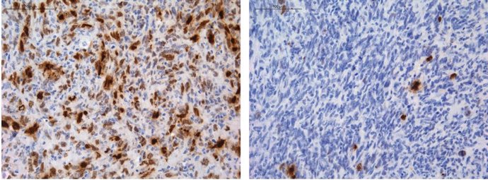 Células de glioma (en azul) bajo tratamiento con temozolomida, con daño en el ADN marcado en color marrón.