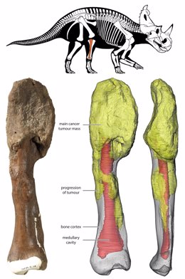 La masa tumoral principal está en la parte superior del hueso y se puede ver en la reconstrucción 3D en amarillo