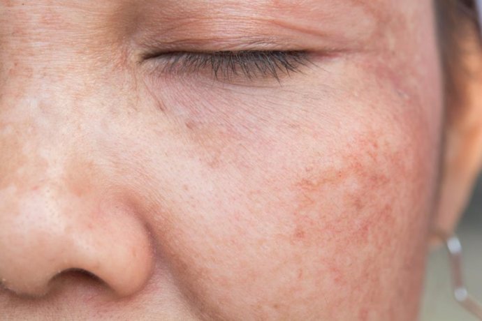 Melasma, pigmentación de la piel, láser en Dermatología