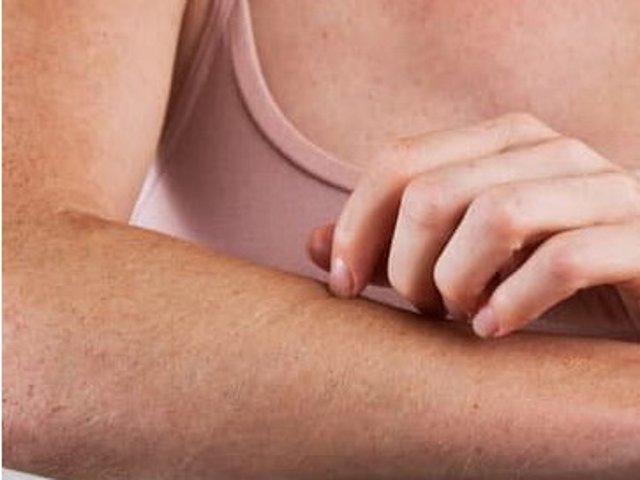 La piel irritada es habitual en verano y es un problema bastante molesto