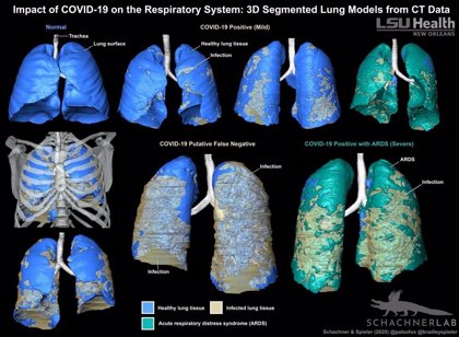 Los modelos 3D, útiles para 'ver' el COVID-19 en los pulmones