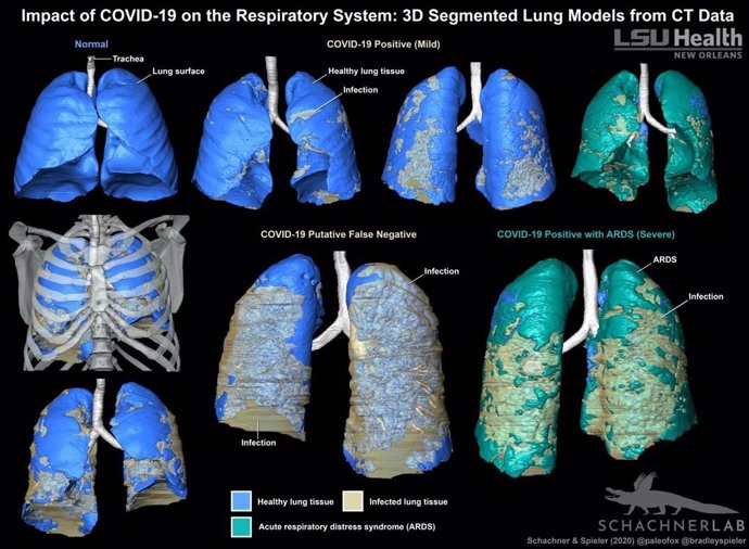 Los modelos 3D son un método sorprendentemente claro para evaluar visualmente la distribución de la infección relacionada con COVID-19 en el sistema respiratorio.