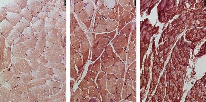 Las muestras de tejido muscular de pacientes con cáncer de páncreas muestran que el aumento de los niveles de la enzima NOX4 (rojo) se correlaciona con el aumento de los niveles de degeneración muscular.