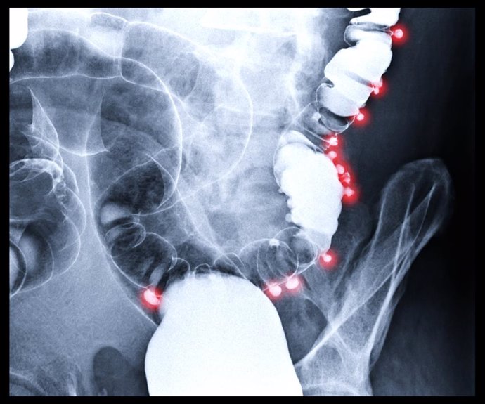 Imagen de enema de bario o imagen de rayos x del intestino grueso mostrando la diverticulitis de colon transverso.