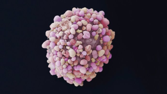 Identifican una molécula clave responsable del mal pronóstico del cáncer de mama