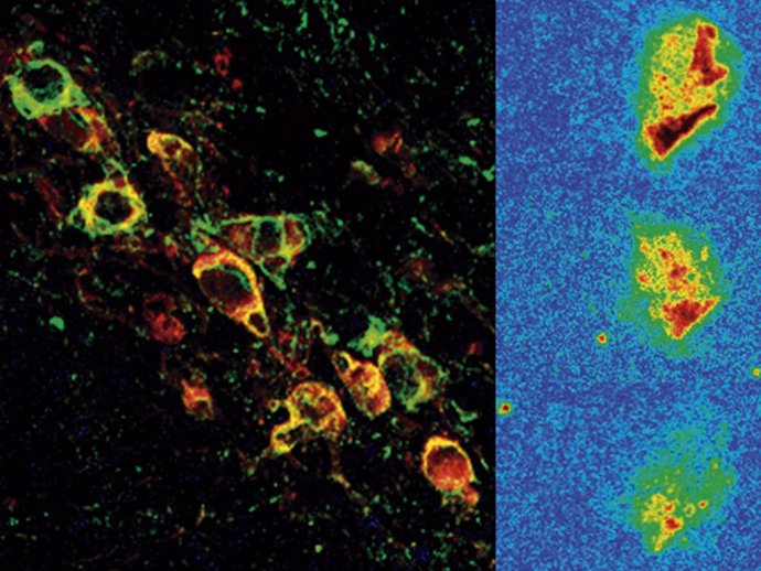 Neuronas dopaminérgicas expresando la forma humana de alfa-sinucleína vistas por microscopia confocal (izq) y reducción progresiva de la expresión de alfa-sinucleína después del tratamiento (dcha)