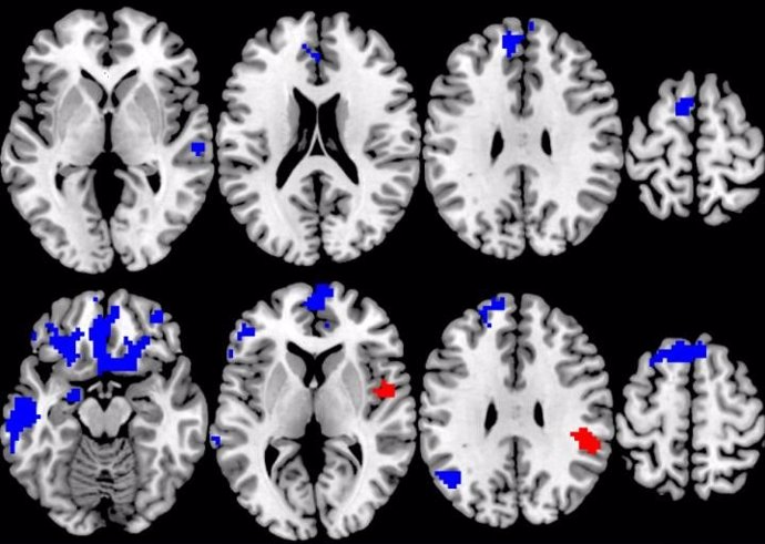 Una compilación de imágenes cerebrales del estudio de la respuesta al tratamiento del trastorno obsesivo-compulsivo y su correlación con la activación durante las tareas de procesamiento cognitivo y de recompensa.
