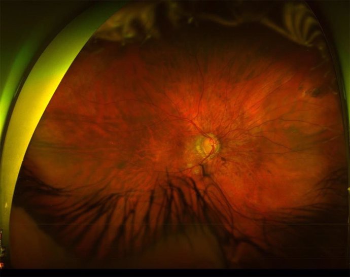 Desprendimiento de retina donde hay que realizar una cirugía