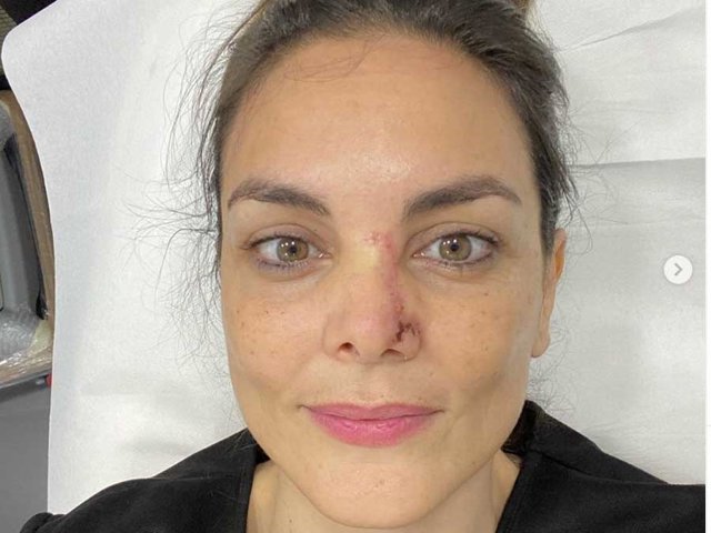 La periodista de Antena 3 Informativos ha vuelto al trabajo tras superar un cáncer de piel en la nariz