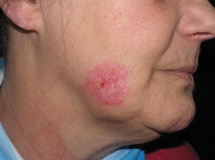 El diagnóstico del lupus y su seguimiento, claves para la calidad de vida de los pacientes afectados por la enfermedad