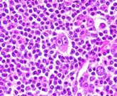 Foto: Expertos destacan el impacto en la calidad de vida de los pacientes con linfoma cutáneo de células T