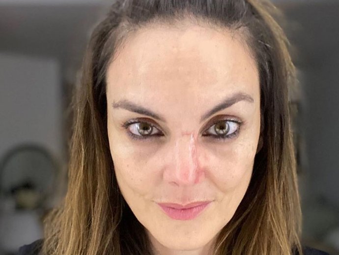 La presentadora de Antena 3 informativos está totalmente recuperada del cáncer de piel en la nariz que acaba de padecer